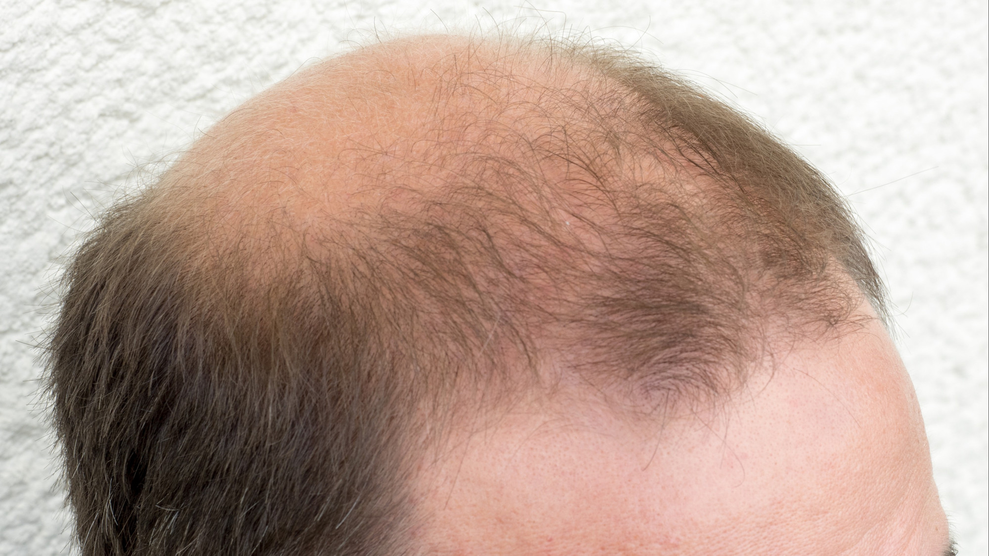 Hair loss is a harsh reality for men?  – 98.5 Montreal