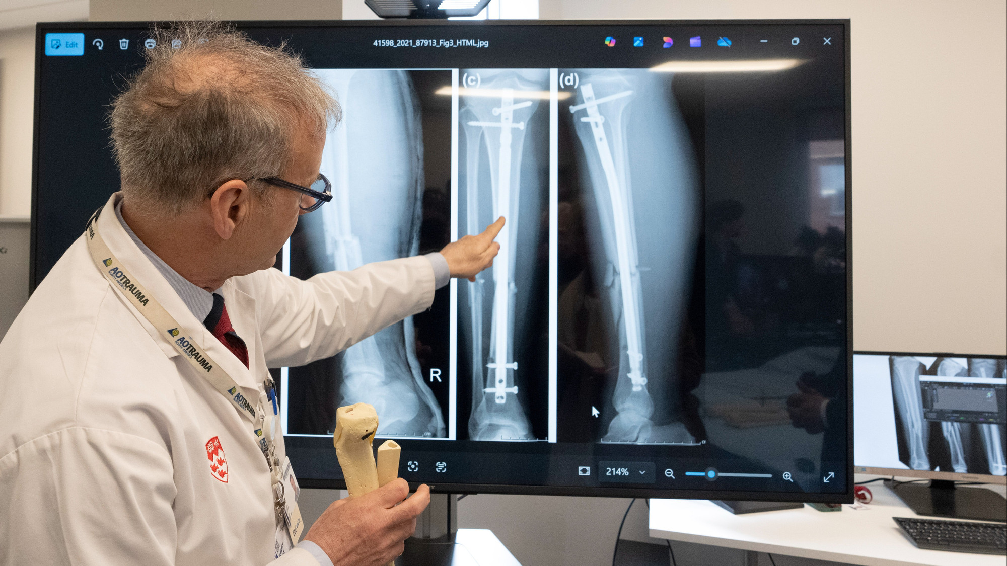 Chirurgies Sportives : L'Attente S'Allonge et Crée l'Impuissance chez les Patients